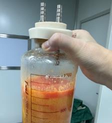 盱眙水动力吸脂手术要做多久？